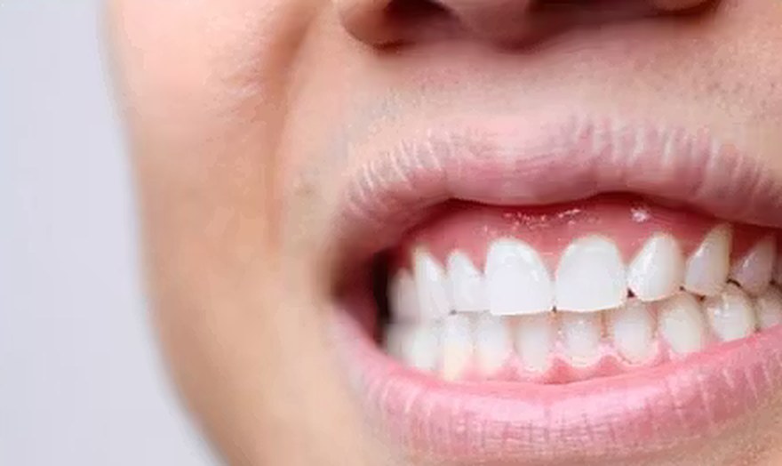 Filip Thai's teeth after 8 treatments