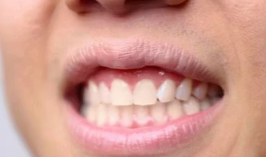 Filip Thai's teeth before