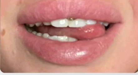 Jill Larsson's teeth after the whitening course