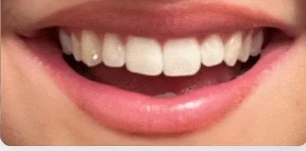 Mimi Cronquist's teeth after the whitening course