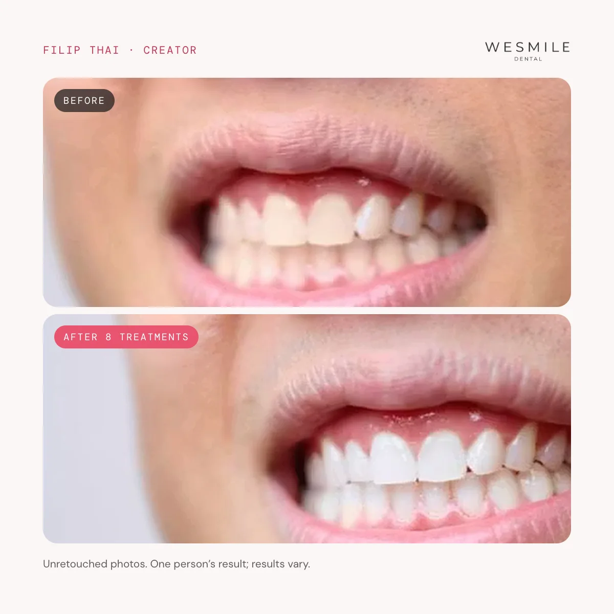 Filip Thai, before and after 8 treatments